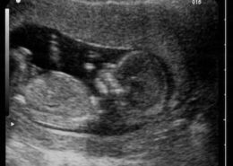 Prenatal Ultrasounds Los Angeles