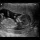 Prenatal Ultrasounds Los Angeles